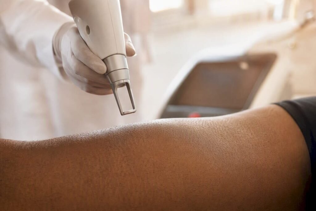 Piece a main de laser Nd:YAG appliquee sur une peau foncee lors d une seance d epilation